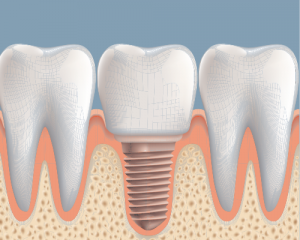 'dental implant in between teeth'